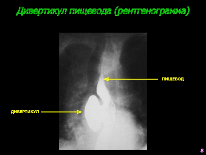 Презентация дивертикул пищевода