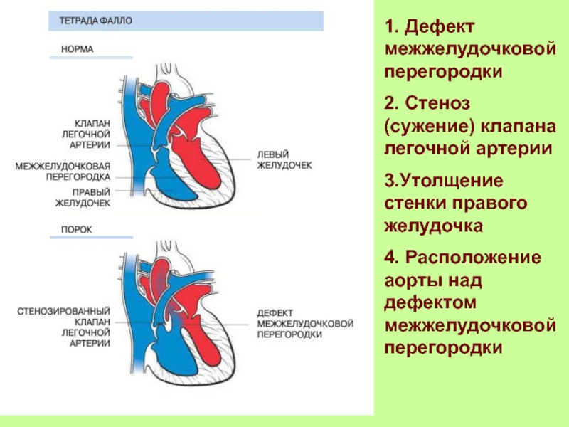 Тетрада фалло картинки