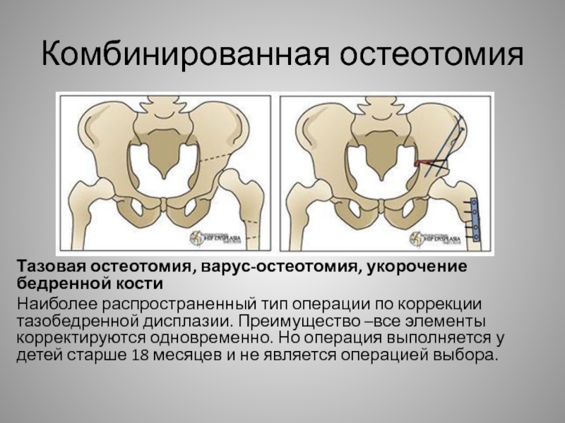 Дисплазия тазобедренных суставов у новорожденных