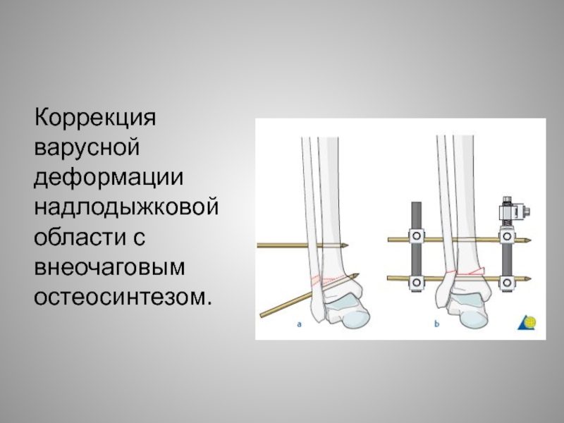 Операция остеосинтез. Операции варусной деформации. Корригирующие операции при деформации суставов. Внеочаговый остеосинтез. Операции остеосинтеза при варусной деформации Москва.