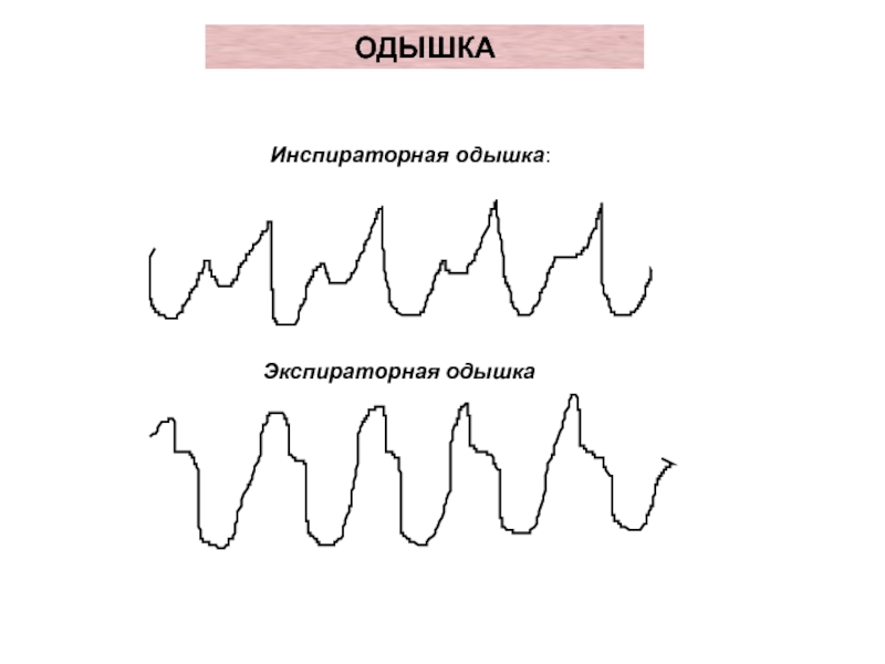 Инспираторная одышка