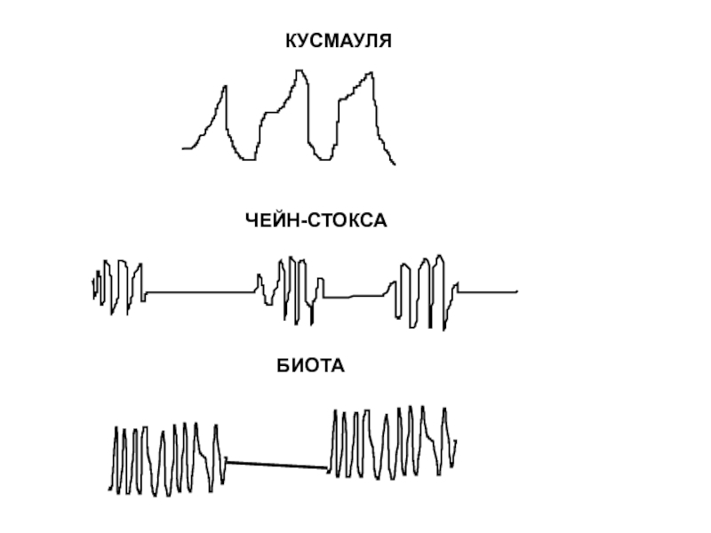 Дыхание куссмауля рисунок