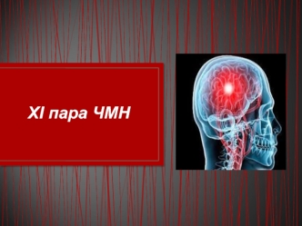 Ураження ХІ пари черепно-мозкових нервів