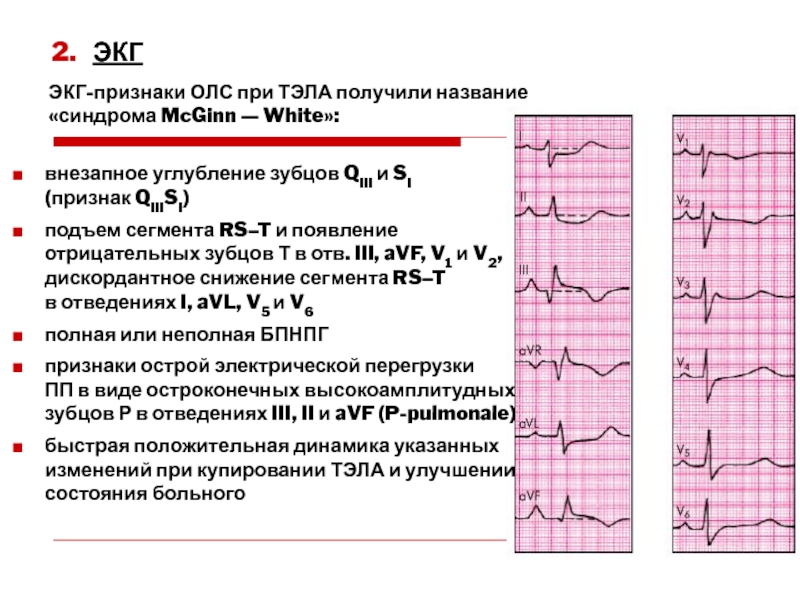 Ибс брадикардия карта вызова