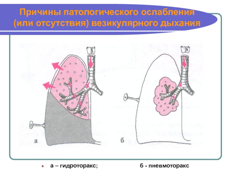 Что такое гидроторакс. Гидроторакс и пневмоторакс. Объем гидроторакса по кт. Пневмоторакс и гидроторакс презентация.