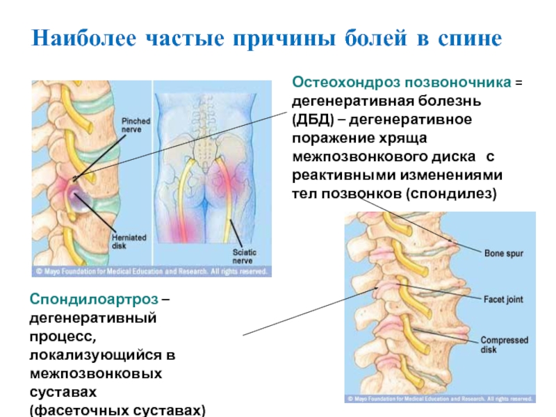 Спондилоартроз лечение