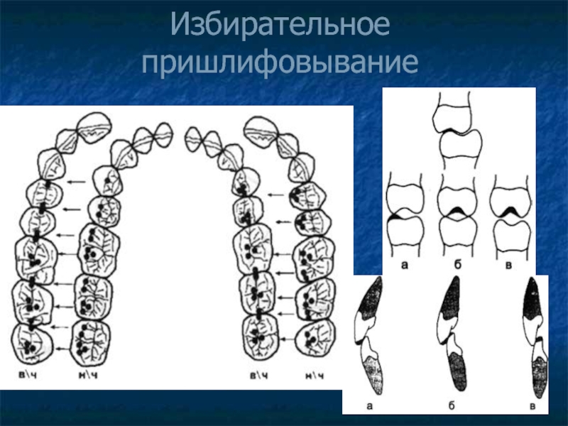 Избирательное пришлифовывание зубов презентация