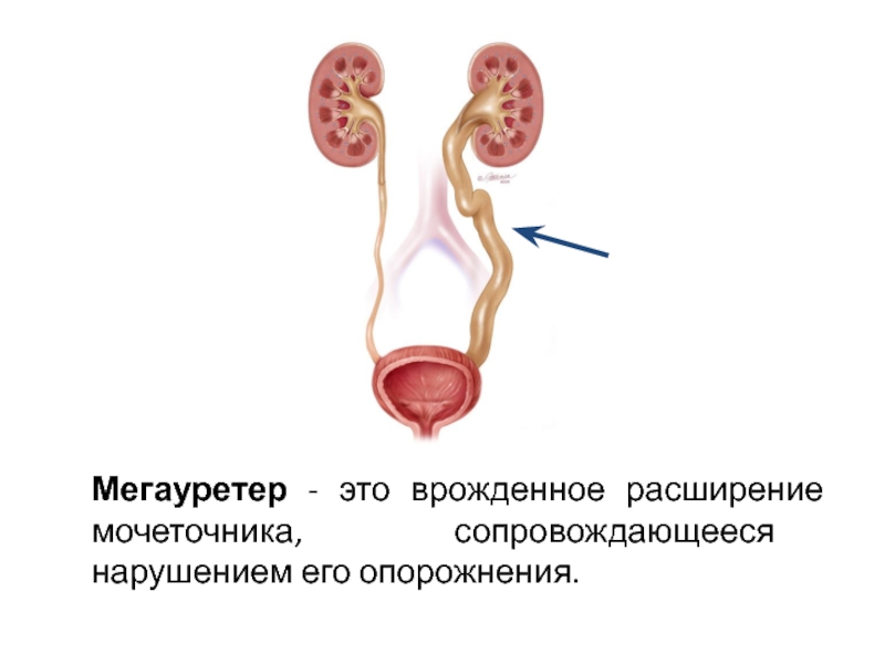 Мочеточник у женщин фото