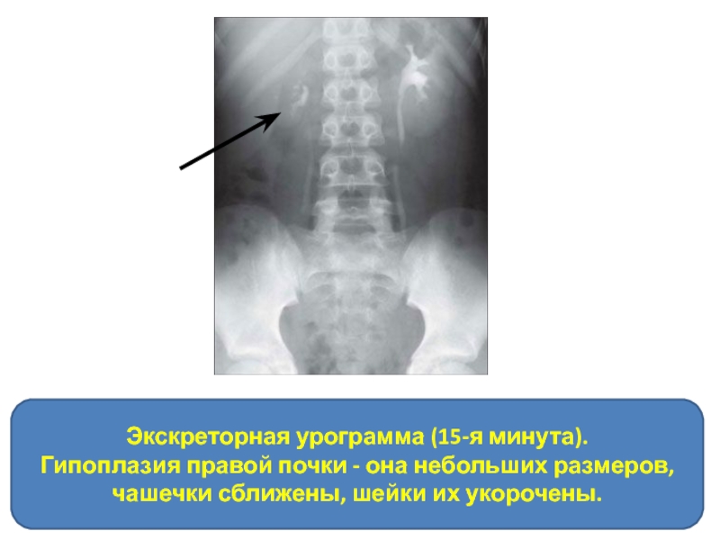 Экскреторная урография картинки