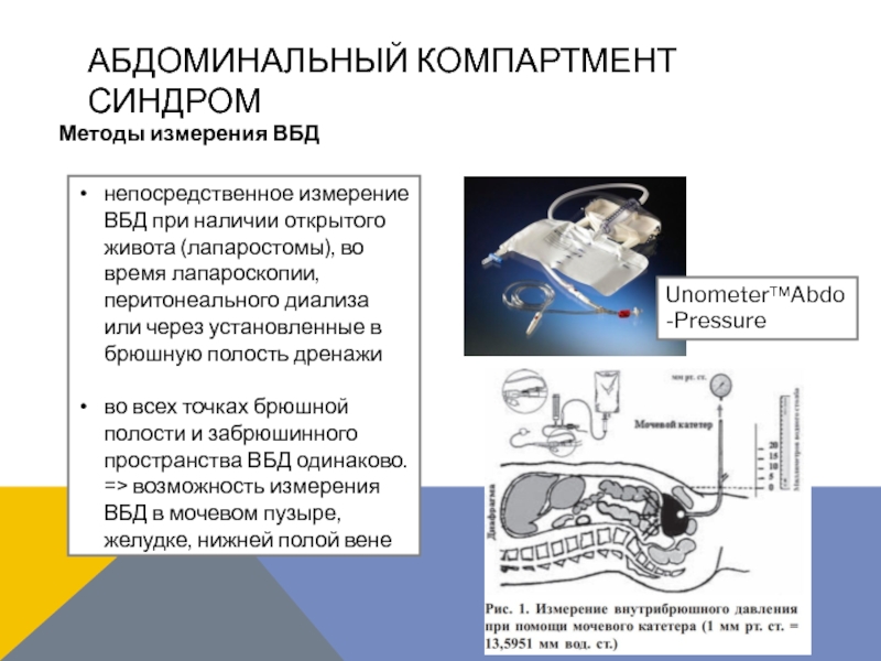 Абдоминальный компартмент синдром. Абдомальное компактиент синдром. Измерение давления в брюшной полости. Внутрибрюшной компартмент синдром.