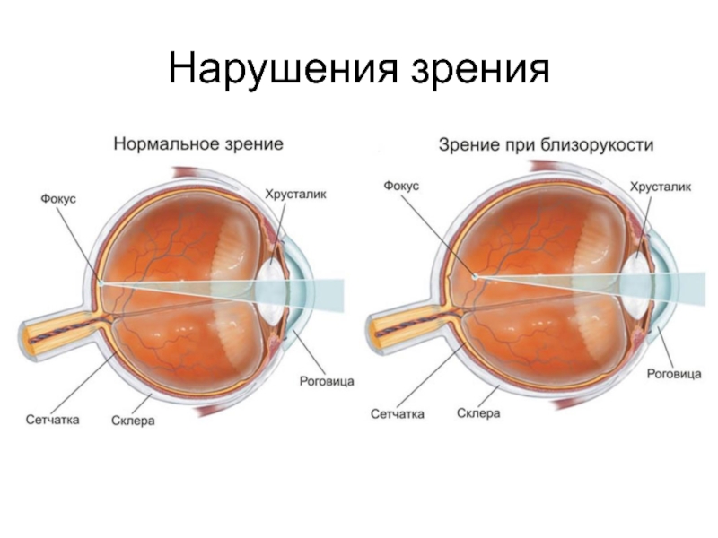 Фокусировка изображения у людей с нормальным зрением происходит в структуре глаза которая