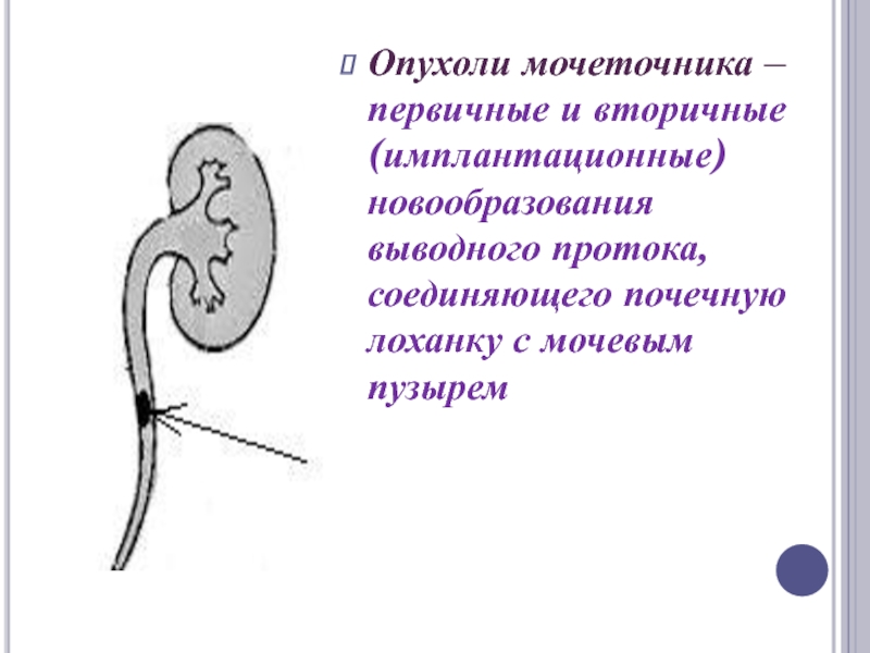 Опухоль почечной лоханки презентация