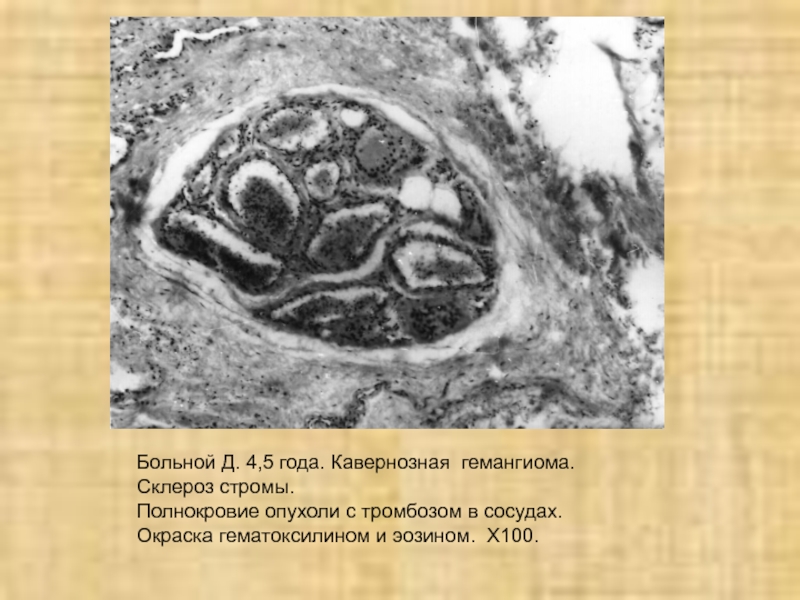 Кавернозная гемангиома. Окраска гематоксилином и эозином. Кавернозная гемангиома гистология.