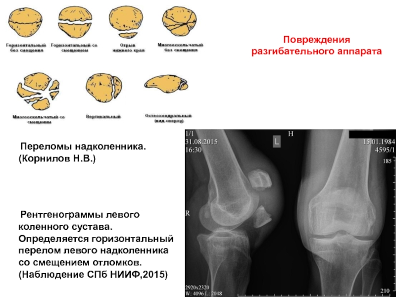 Закрытый перелом коленного сустава карта вызова