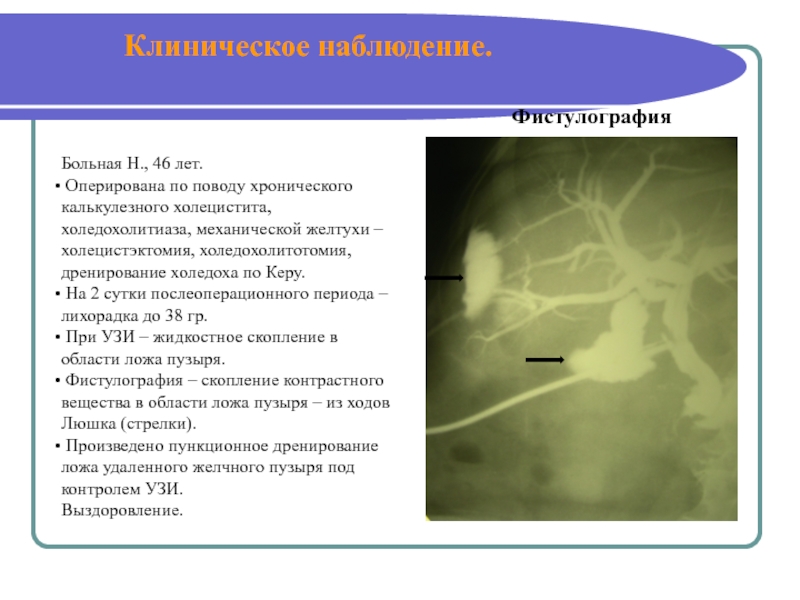 Состояние после холецистэктомии код