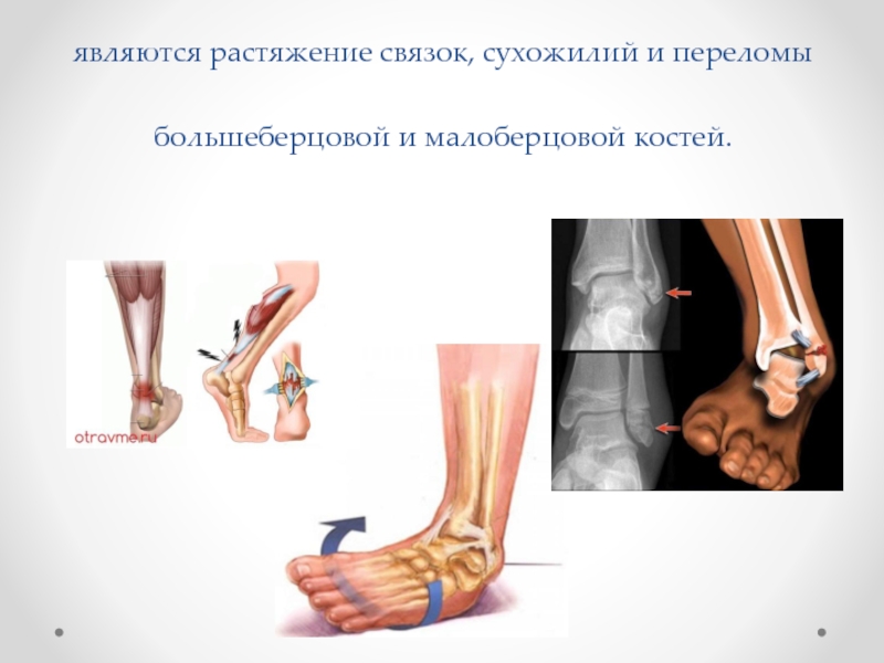 Реферат: Переломы лодыжек, повреждения голеностопного сустава