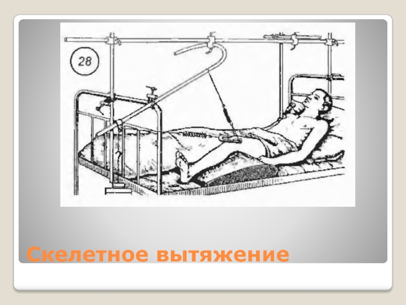 Скелетное вытяжение. Скелетное вытяжение при переломе вертлужной впадины. Скелетное вытяжение таза. Демпферное скелетное вытяжение. Скелетное вытяжение иммобилизация.