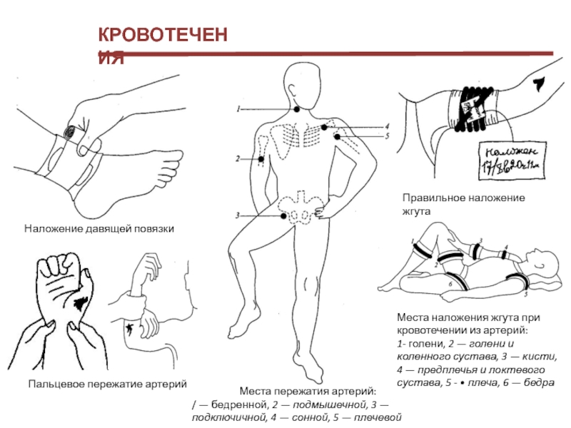 При кровотечении из артерии накладывается. Места наложения жгута при кровотечении. Наложение жгута и давящей повязки при кровотечениях. Наложение жгута на бедренную артерию.