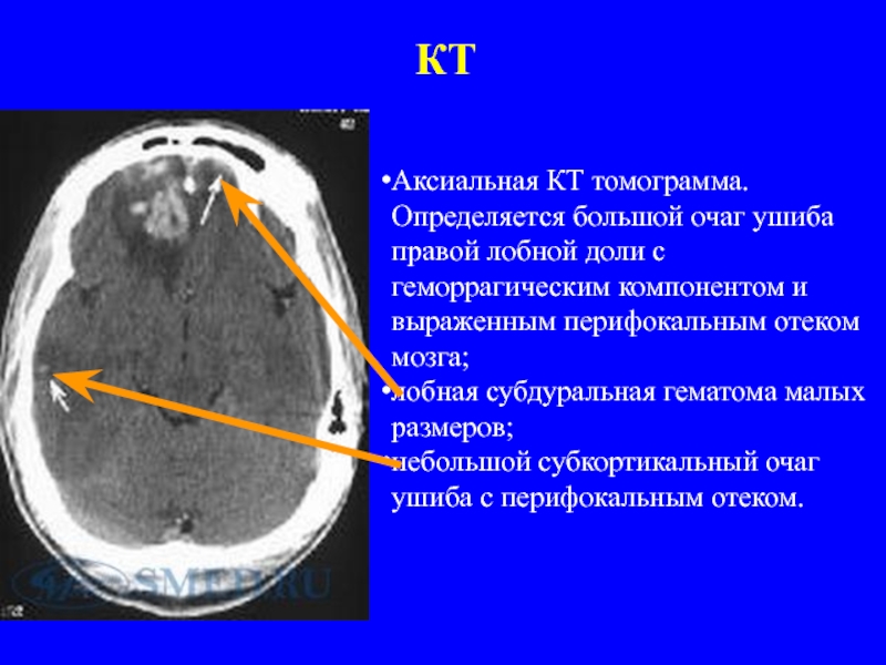 Единичный очаг в левой лобной доле. Субдуральная гематома лобных долей кт. Перифокальный отек головного мозга на кт. Субкортикальный очаг головного мозга в лобной доле. Перифокальный отек головного мозга мрт.