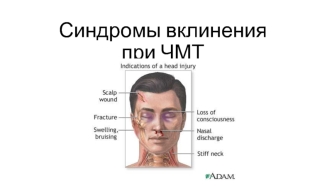 Синдромы вклинения при ЧМТ