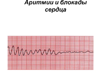 Аритмии и блокады сердца