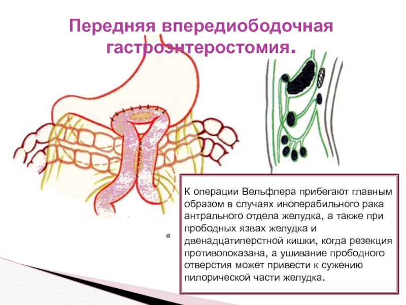 Анастомоз по брауну схема