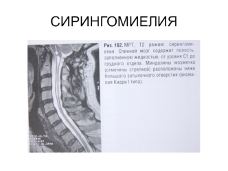 Сирингомиелия. Сегментарно-диссоциированныйтип расстройства чувствительности