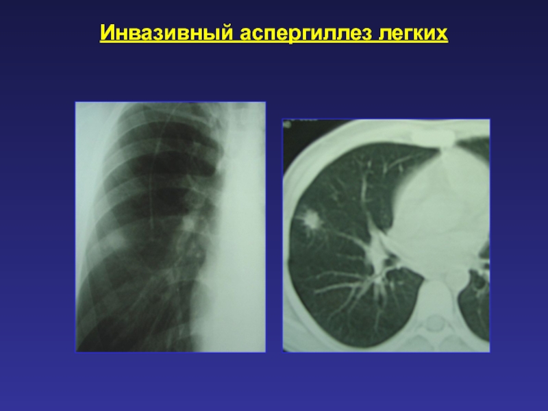 Аллергический бронхолегочный аспергиллез презентация