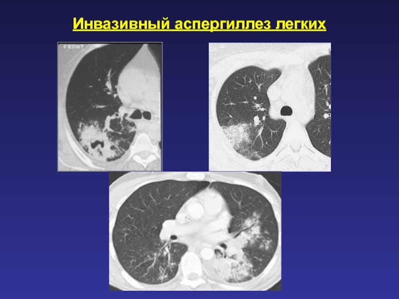 Аспергиллез легких презентация