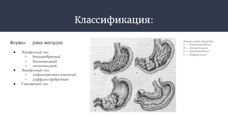 Рак желудка патанатомия презентация