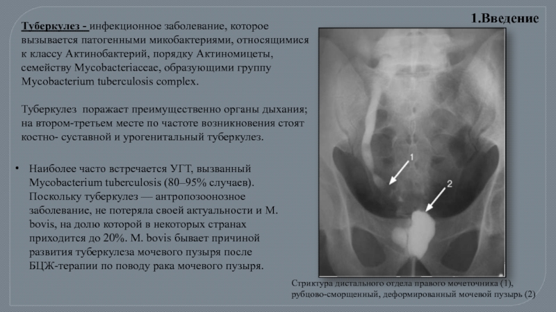 Туберкулез мочевыделительной системы презентация