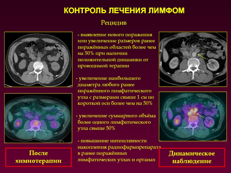 Контроль терапии. Лимфопролиферативное заболевание на кт. Лимфопролиферативное заболевание легких на кт. Лимфопролиферативные заболевания брюшной полости на кт. Лимфопролиферативный процесс на кт.