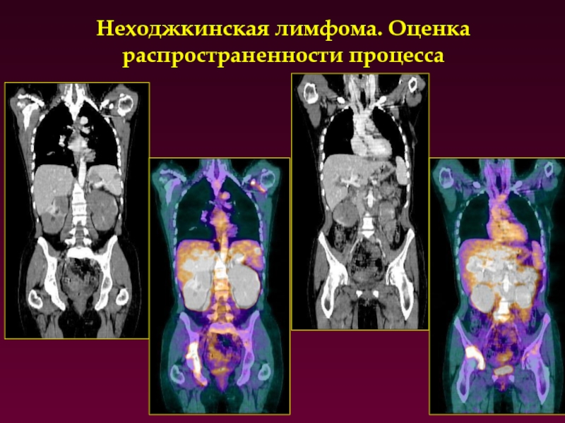 Неходжкинская лимфома презентация