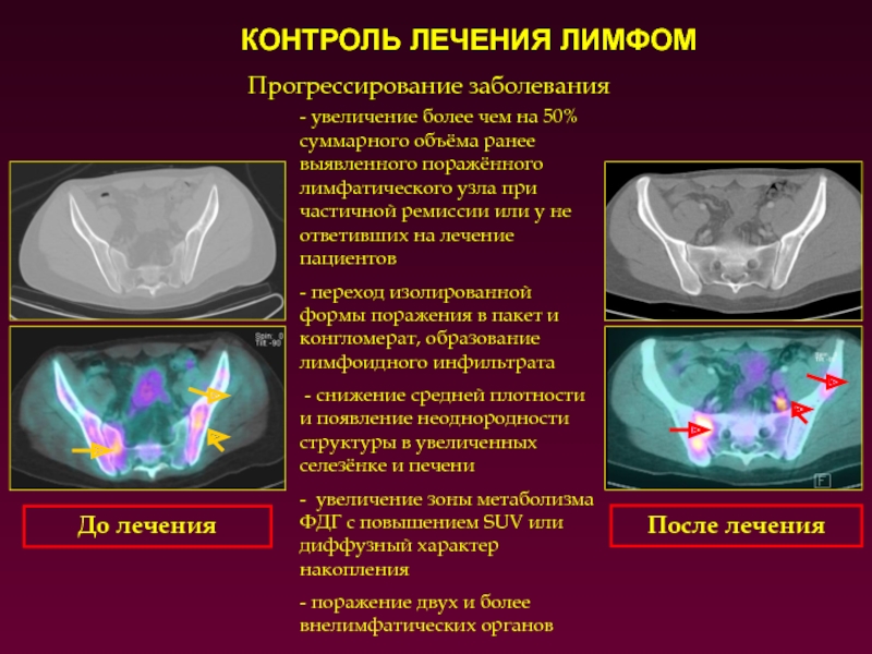 Лечение лимфом. Болезнь контролирующая терапия. Лимфопролиферативное заболевание кт диагностика.