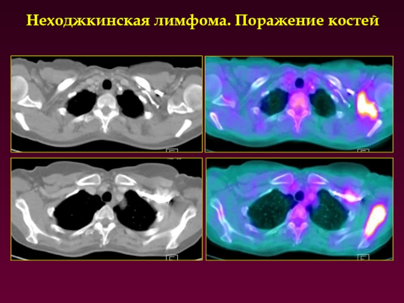 Неходжкинская лимфома. Неходжскинская лисыома. Нишхослинская лимфома. Неходжкинские лимфомы кт.