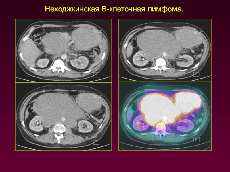 Неходжкинские лимфомы. Лимфома неходжкинская в-клеточная. Неходжкинская лимфома кт. Неходжкинская лимфома рентгенодиагностика. Неходжкинская лимфома клетки.