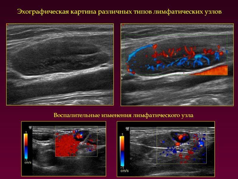 Эхографическая картина. Инволютивные изменения лимфатических узлов. Эхографическая картина лимфатического узла. Лимфопролиферативные изменения лимфоузлов УЗИ. Реактивные изменения лимфатических узлов.