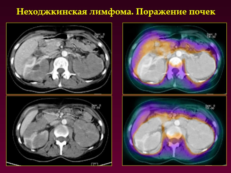 Неходжкинская лимфома. Неходжкинская лимфома кт. Неходжкинская лимфома и ходжкинская кт.