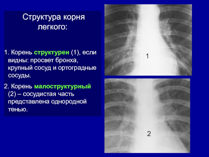 Легочный рисунок обогащен по смешанному типу корни малоструктурны что это значит