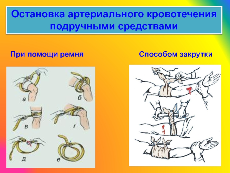 Способы временной остановки кровотечения картинки