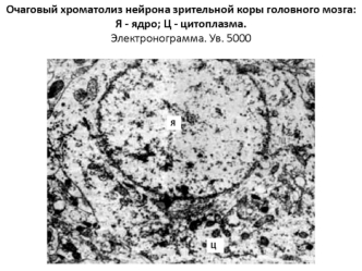 Очаговый хроматолиз нейрона зрительной коры головного мозга