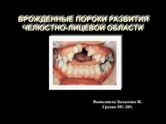 Врожденные пороки развития челюстно-лицевой области