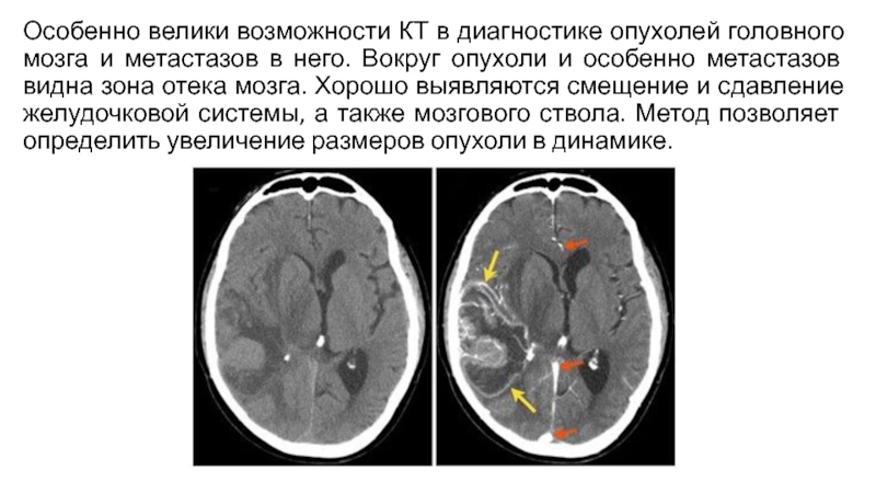 Реферат: Магнитно-резонансная томография в диагностике опухолей головного мозга