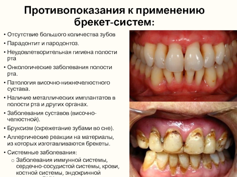 Противопоказания к применению брекет-систем: Отсутствие большого количества зубовПарадонтит и пародонтоз.Неудовлетворительная гигиена полости