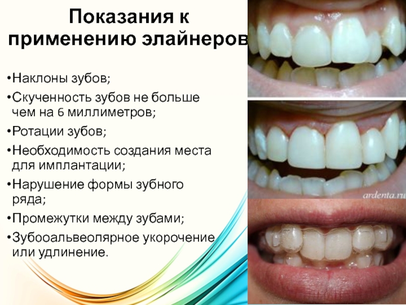 Показания к применению элайнеров Наклоны зубов;Скученность зубов не больше чем на 6