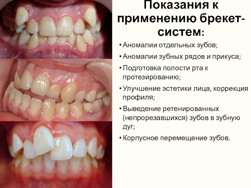 Показания к применению брекет-систем:Аномалии отдельных зубов;Аномалии зубных рядов и прикуса;Подготовка полости рта