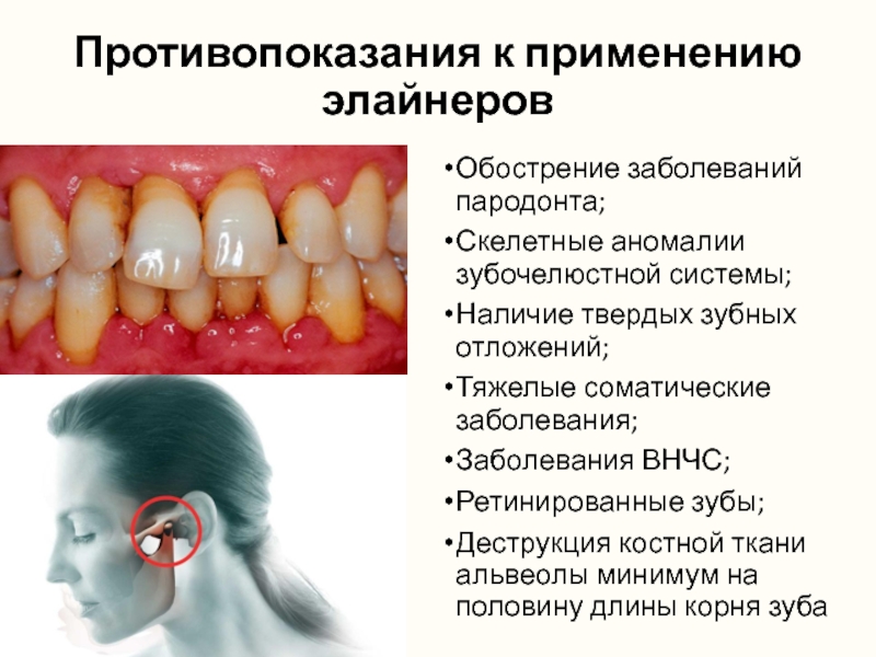 Противопоказания к применению элайнеров Обострение заболеваний пародонта;Скелетные аномалии зубочелюстной системы;Наличие твердых зубных