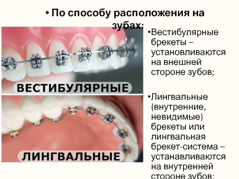 Вестибулярные брекеты – установливаются на внешней стороне зубов;Лингвальные (внутренние, невидимые) брекеты или