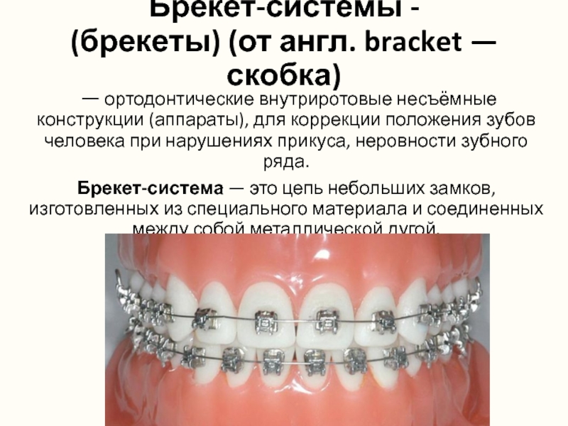Брекет-системы - (брекеты) (от англ. bracket — скобка) — ортодонтические внутриротовые несъёмные конструкции (аппараты), для коррекции положения зубов человека при нарушениях прикуса,