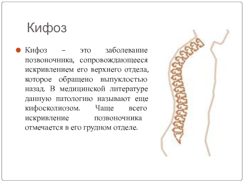 Кифоз позвоночника у подростков